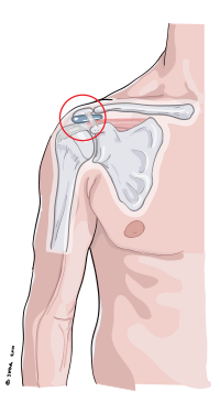 Impingement