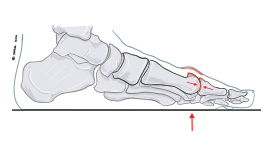 hallux rigidus