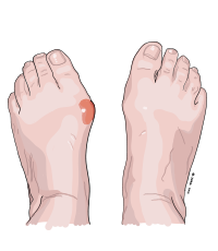 hallux valgus